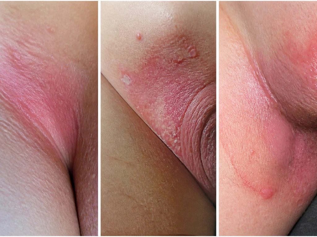 Split-screen en trois vignettes : irritations de peau comparées (urine vs mycose vs autre cause) sans texte.